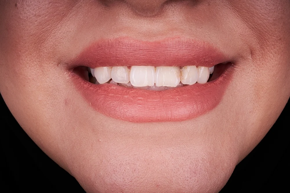 Bonding – na czym polega i kiedy jest zalecany?