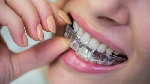 aparat ortodontyczny nakladkowy