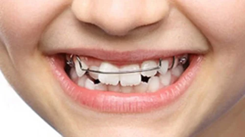 aparat ortodontyczny ruchomy