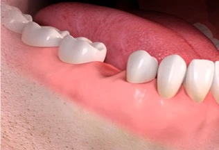 implanty ceramiczne starumann 1