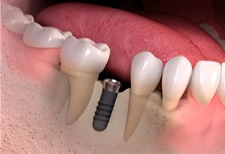 implanty ceramiczne starumann 2