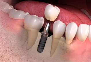 implanty ceramiczne starumann 3