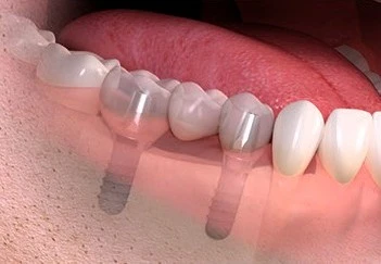 implanty ceramiczne starumann 4